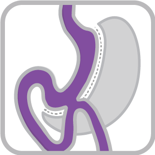 Mini Gastric Bypass (Omega Loop)