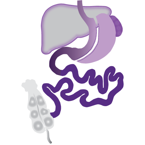 mini gastric sleeve
