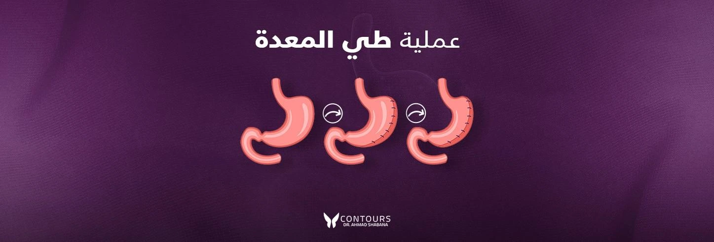 عملية طي المعدة في مصر مع د. أحمد شبانة | كل ما تحتاج معرفته